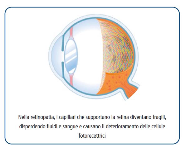 Pycnogenol proteggei capillari della retina